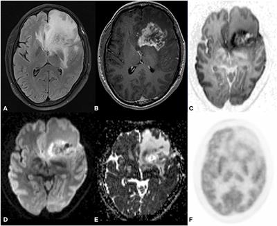 Can High b Value Diffusion Be a Surrogate Marker for PET—A MR/PET Study in Neurooncology Set Up